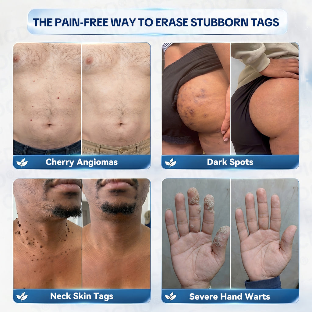 𝐏𝐢𝐜𝐝𝐨® 7-𝐃𝐚𝐲 𝐒𝐤𝐢𝐧 𝐓𝐚𝐠 & 𝐒𝐩𝐨𝐭 𝐄𝐫𝐚𝐬𝐞𝐫 𝐂𝐫𝐞𝐚𝐦 (Zero Pain, Zero 𝐒𝐜𝐚𝐫𝐬 Formula) 🎉