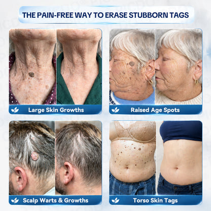 𝐏𝐢𝐜𝐝𝐨® 7-𝐃𝐚𝐲 𝐒𝐤𝐢𝐧 𝐓𝐚𝐠 & 𝐒𝐩𝐨𝐭 𝐄𝐫𝐚𝐬𝐞𝐫 𝐂𝐫𝐞𝐚𝐦 (Zero Pain, Zero 𝐒𝐜𝐚𝐫𝐬 Formula) 🎉