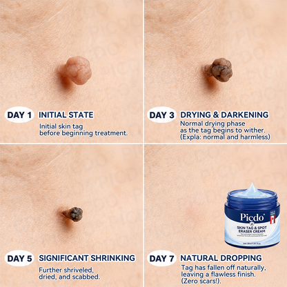 𝐏𝐢𝐜𝐝𝐨® 7-𝐃𝐚𝐲 𝐒𝐤𝐢𝐧 𝐓𝐚𝐠 & 𝐒𝐩𝐨𝐭 𝐄𝐫𝐚𝐬𝐞𝐫 𝐂𝐫𝐞𝐚𝐦 (Zero Pain, Zero 𝐒𝐜𝐚𝐫𝐬 Formula) 🎉