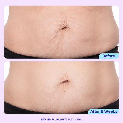 🔥 Best Seller | Tightening & Smoothing Belly Cream